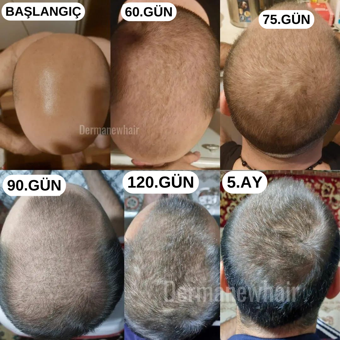 Dermanew: Saçlarınızda Yeni Bir Dönem!